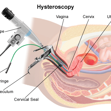 hysteroecopy