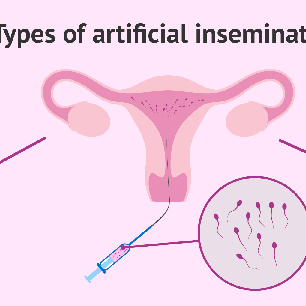 types-of-artificial-insemination-aih-or-aid